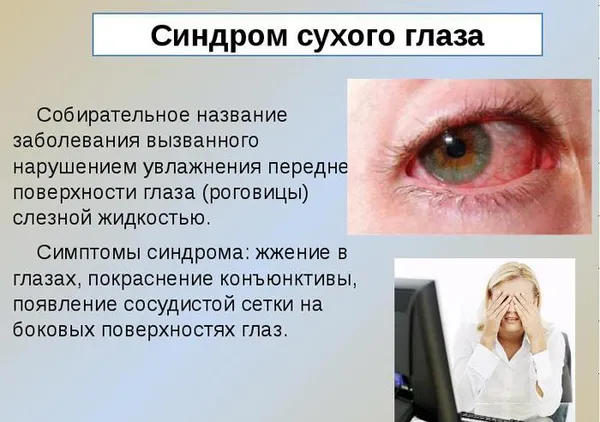 синдром «сухого глаза»